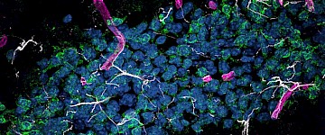 肝脏中制造的蛋白质可能导致大脑中的阿尔茨海默病