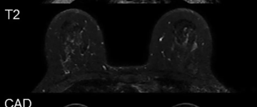 MRI筛查工具可减少乳腺癌筛查中的假阳性